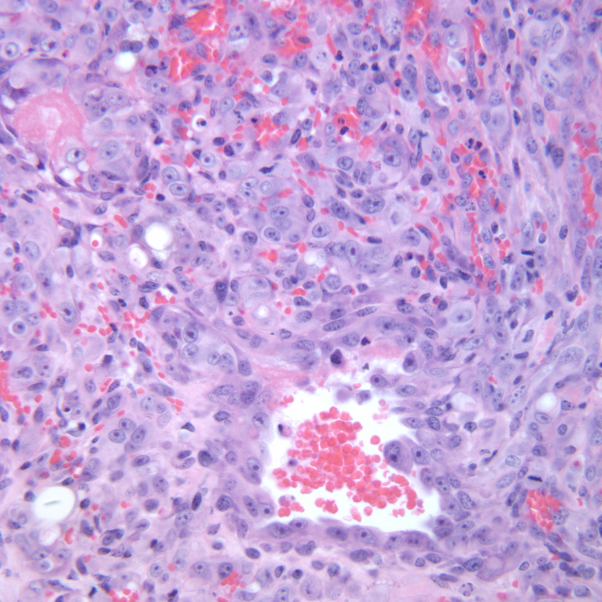 hemangiosarcoma 